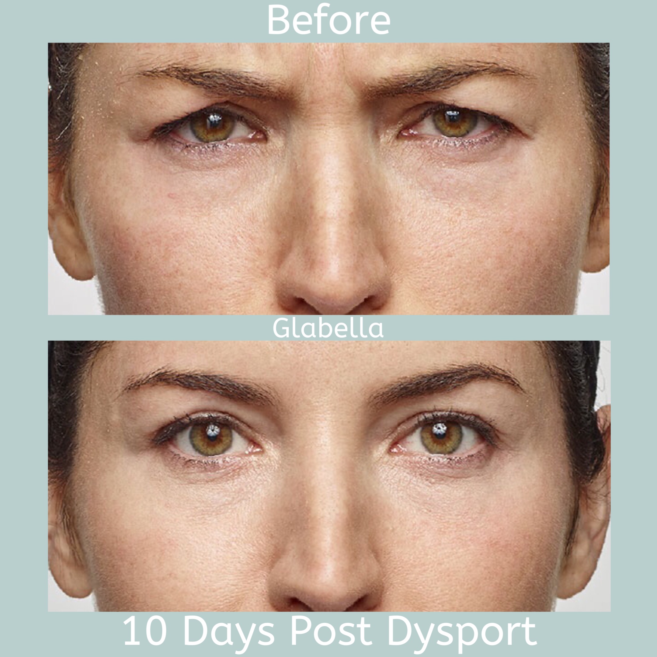 Glabella comparison 10 days post Dysport treatment showcasing smoother skin