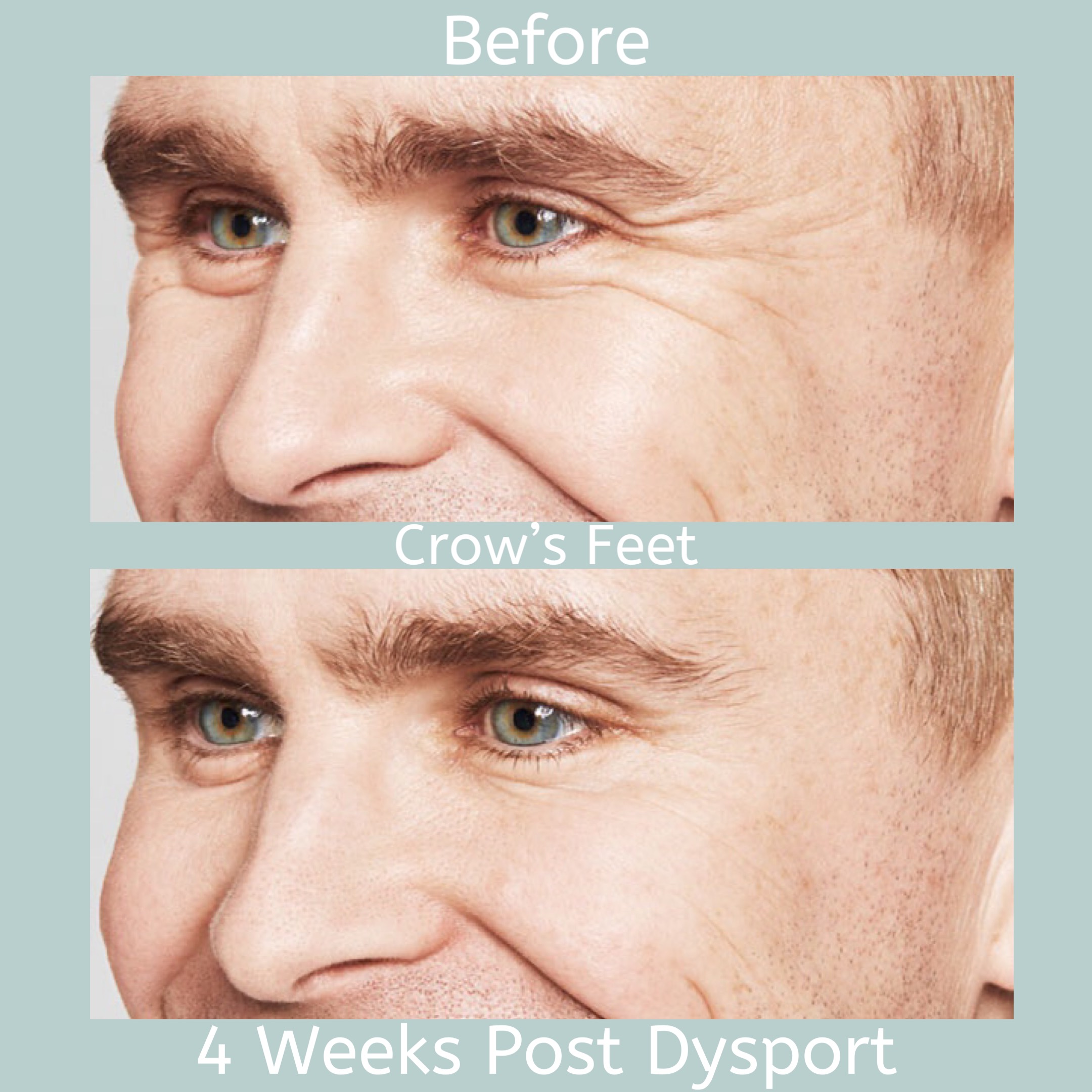Before and after treatment for crows feet highlighting skin rejuvenation results